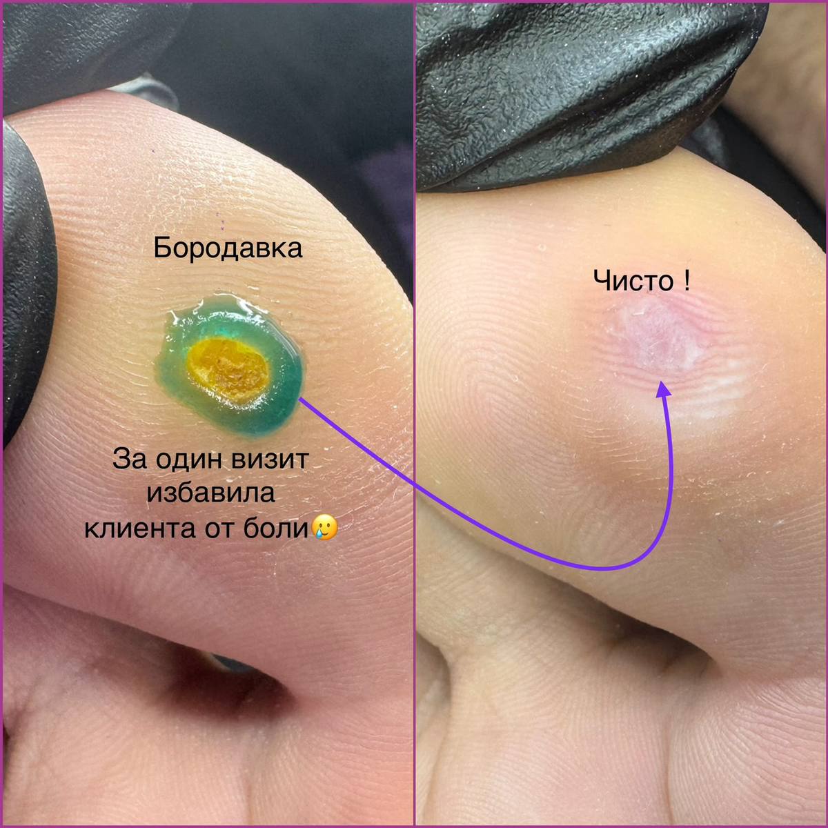 Удаление подошвенной бородавки
